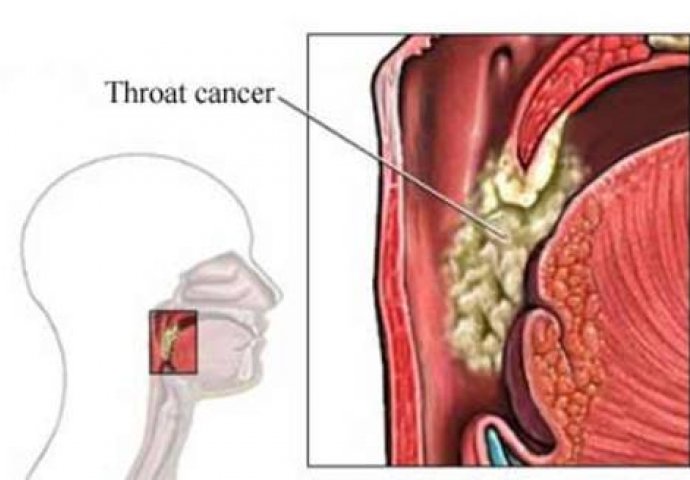 Rak grla – koliko se često javlja i kod koga?