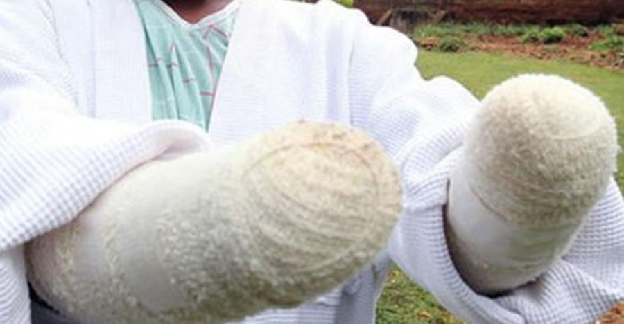 Odsjekao je šake svojoj ženi jer nije mogla da zatrudni: Kada je saznao razlog ostao je šokiran