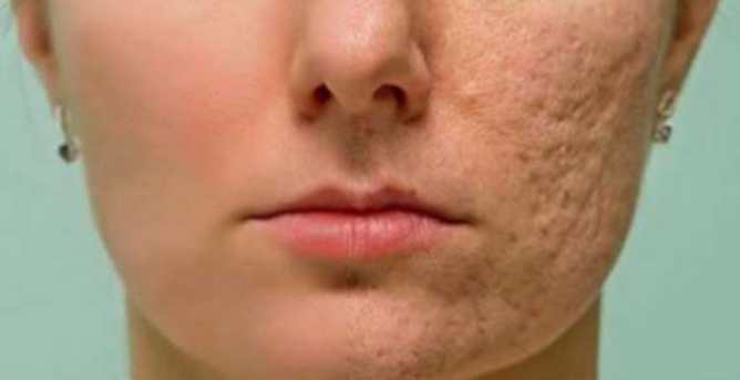 Utrljati na bilo koji Ožiljak,Bore ili Mrlje na vašoj koži i gledajte kako sve nestaje u samo nekoliko minuta