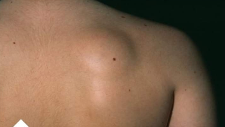 Prirodni recept za uklanjanje masnog tkiva