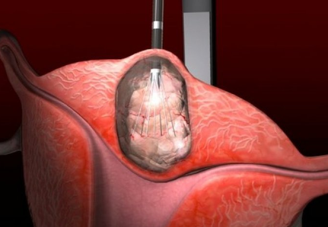 ŽENE, OVO SU SIMPTOMI MIOMA MATERICE: Prvi signal je jasan znak da morate na liječenje