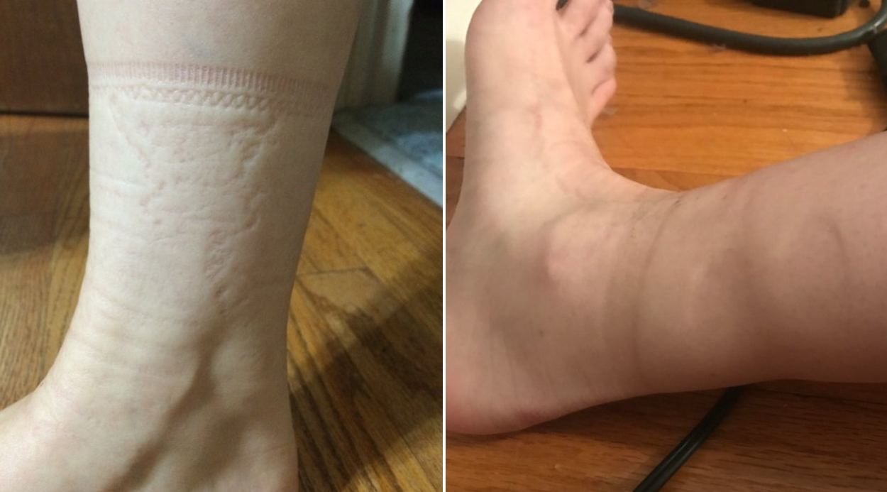 Tragovi od čarapa: Što otkrivaju o vašem zdravlju?