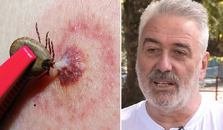 Dr Nestorović OTKRIVA: Riješite se krpelja tako što ćete ga UDAVITI – Potrebne su vam samo 2 STVARI iz kuće