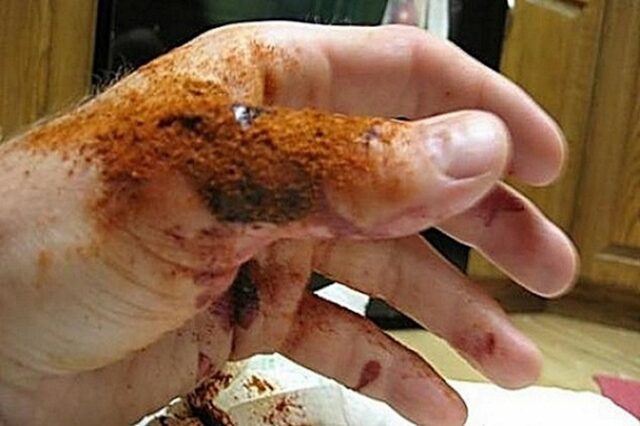 MORATE ZNATI: Prva Pomoć Iz Kuhinje Koja Momentalno Zaustavlja Krvarenje…