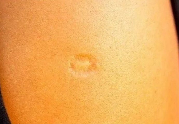 Svi rođeni u Jugoslaviji imaju ovaj ožiljak na ruci: Znate li kako je nastao i zbog čega? Svi su iznenađeni